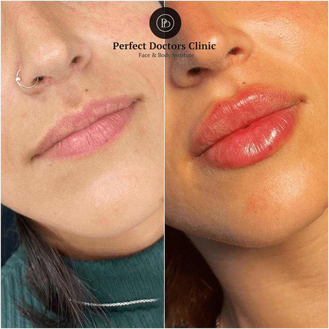 How Juvederm Can Improve Your Profile at the Best Aesthetic Clinic in dubai