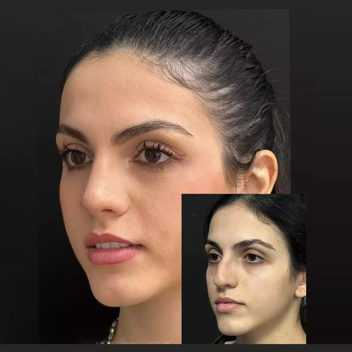 rhinoplasty in dubai