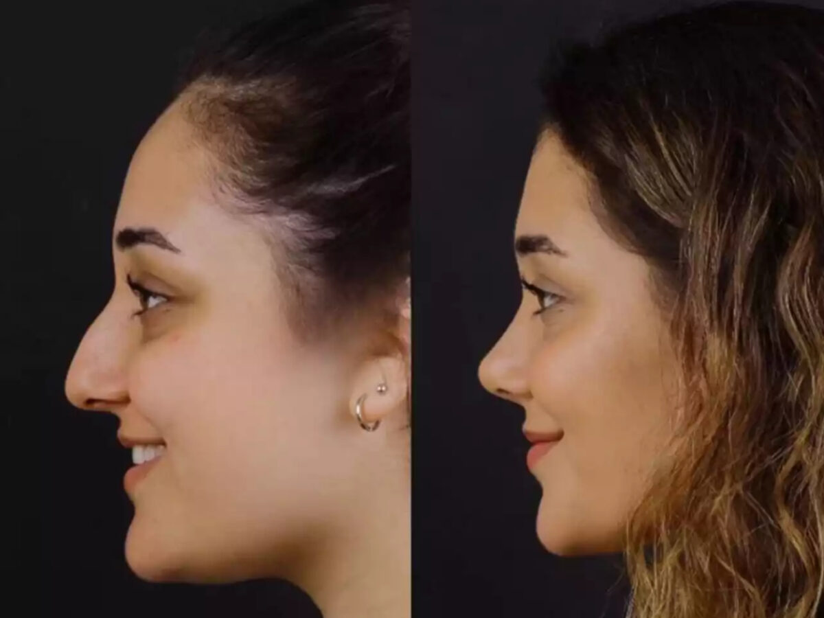 Septoplasty in Dubai: A Solution for Nasal Blockage