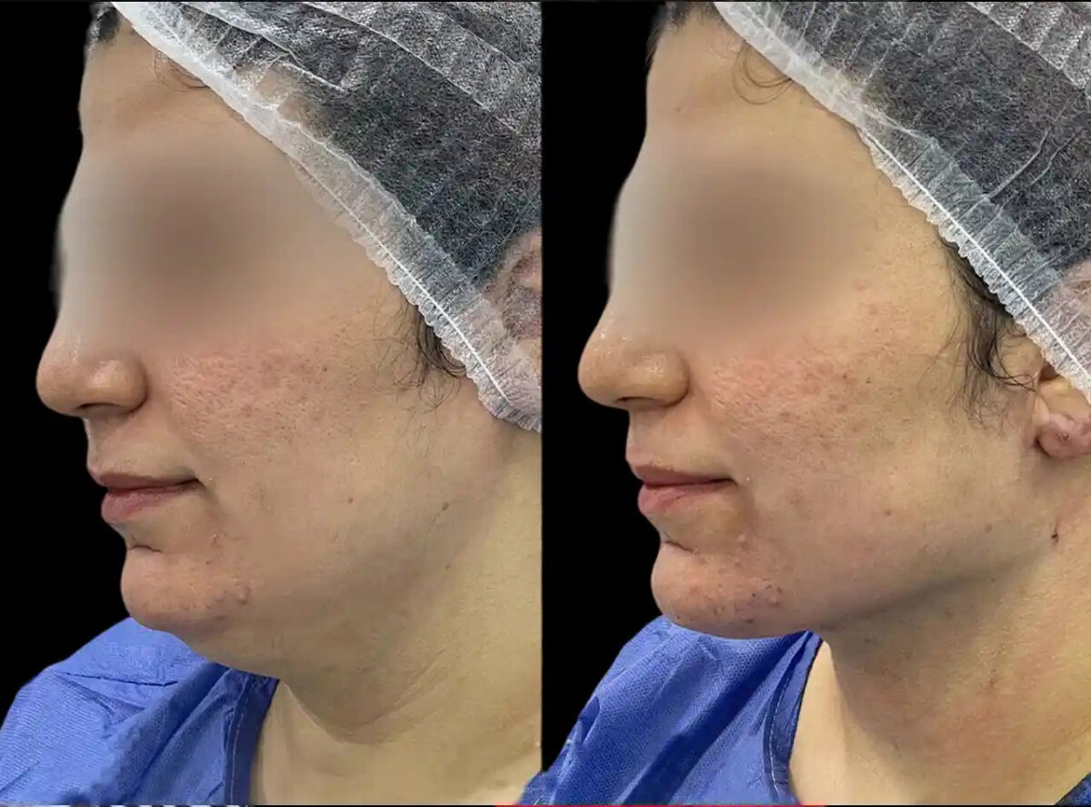 Chin Fillers in Dubai