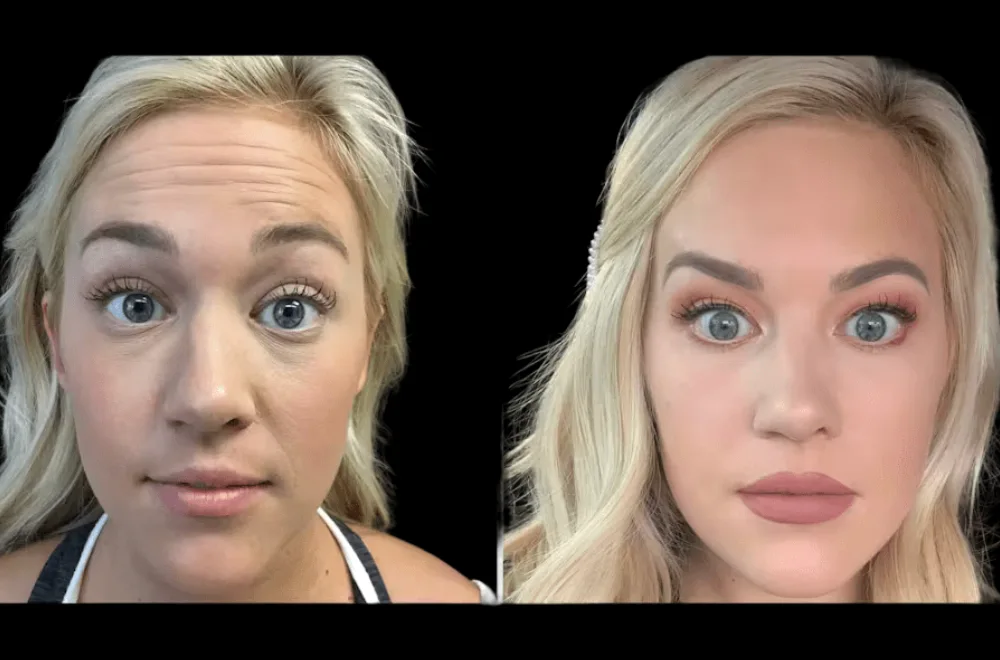 Why Botox Treatment in Dubai Is Becoming the Go-To Anti-Aging Solution