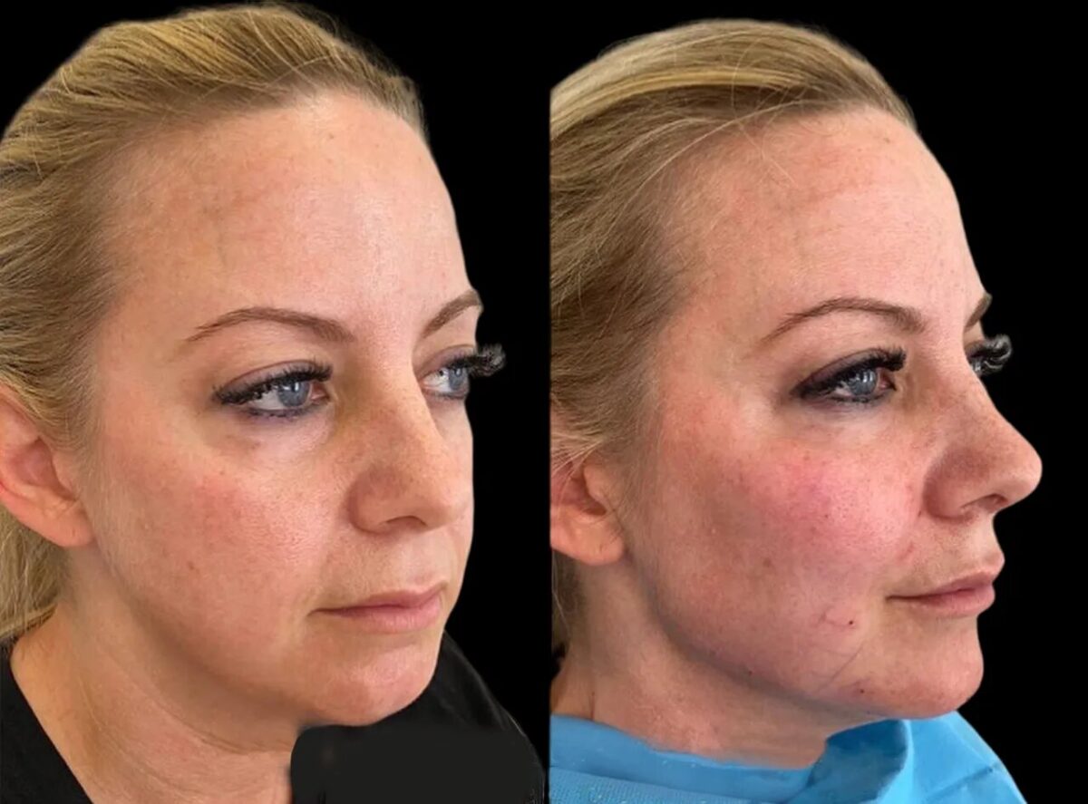Why Cheek Fillers Treatments in Dubai Are Perfect for Busy People