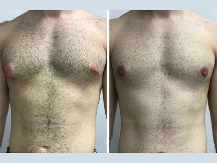 Common Myths About Gynecomastia Surgery in Dubai