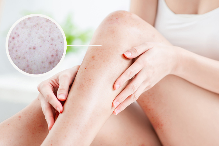 How to Handle Redness After Laser Hair Removal?