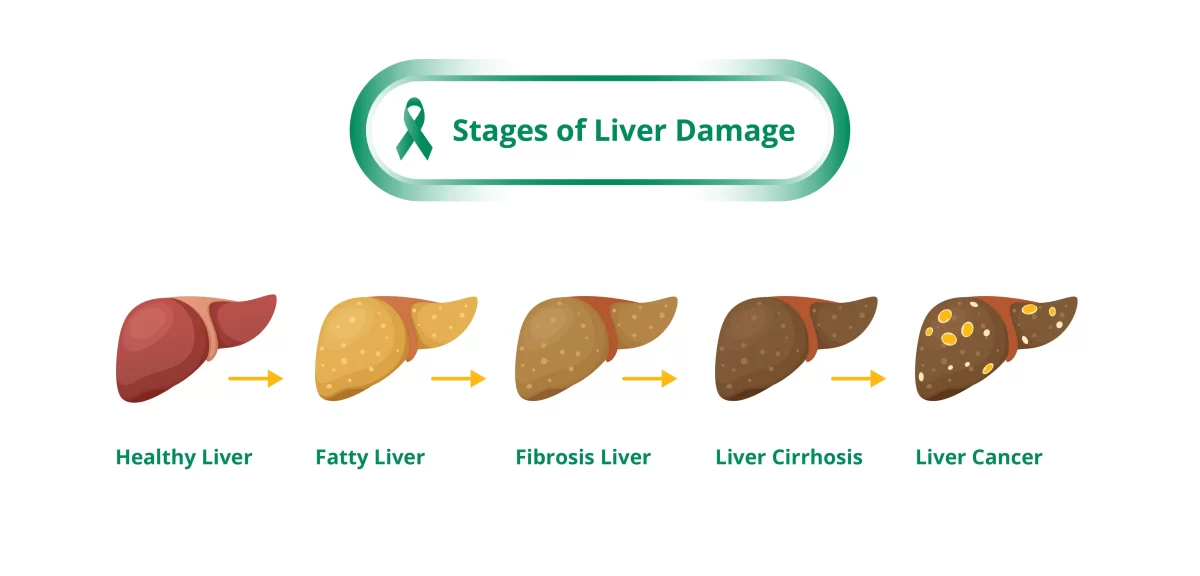 What to Expect During Liver Cancer Treatment in Singapore
