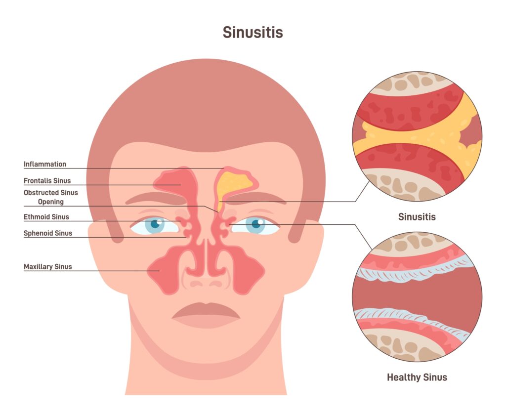 How a Sinus Infection Affects Your Hearing and Balance