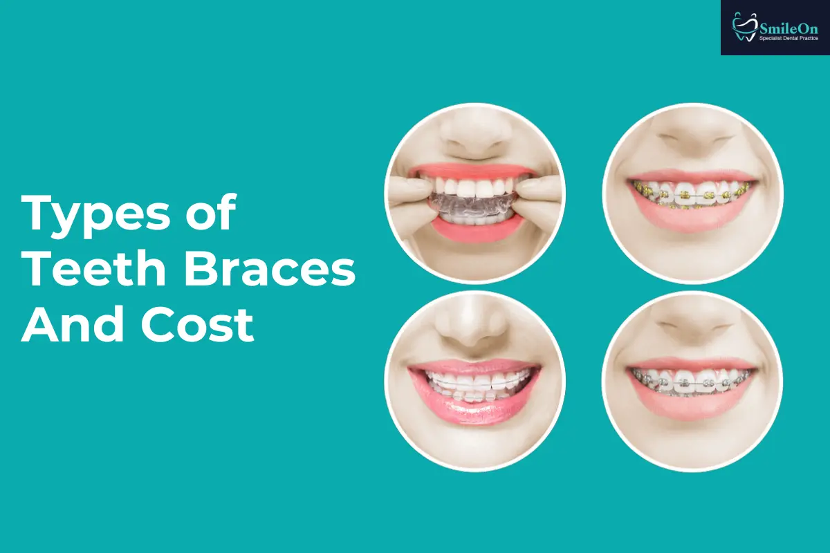 Type of Braces