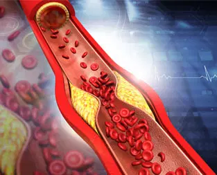 High cholesterolemia Dubai