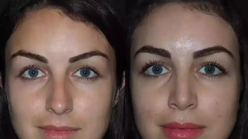 Rhinoplasty in Dubai: Non-Surgical vs Surgical Options