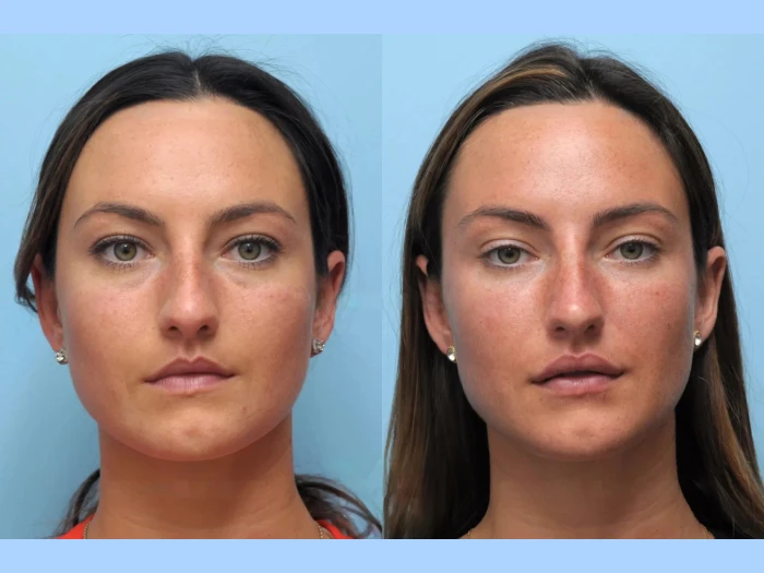 How the Best Doctors in Dubai Are Redefining Thread Lift Techniques