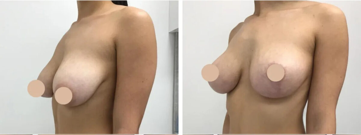breast reduction in dubai