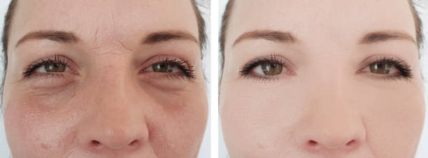 Rejuvenating Your Look: The Science Behind PRF Under Eyes