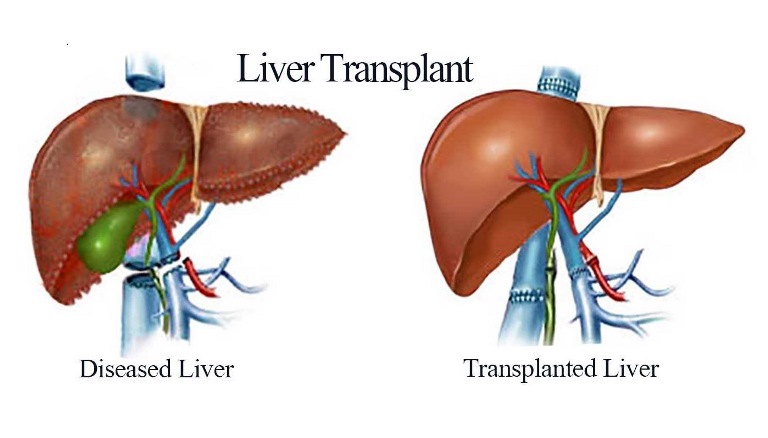 Liver Transplant in Singapore