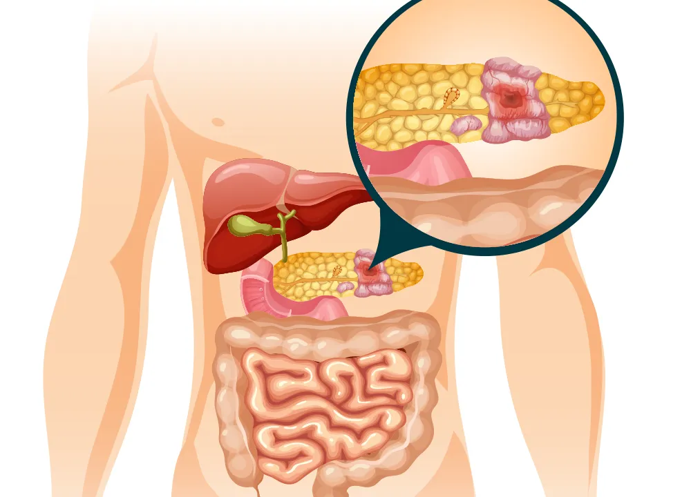 Everything You Should Know About Pancreatic Cancer in Singapore
