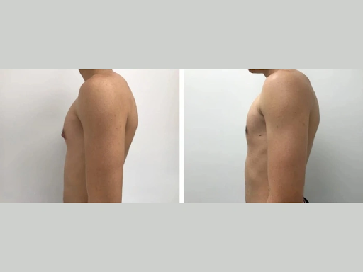 Gynecomastia Surgery Treatment for Expats Living in Dubai